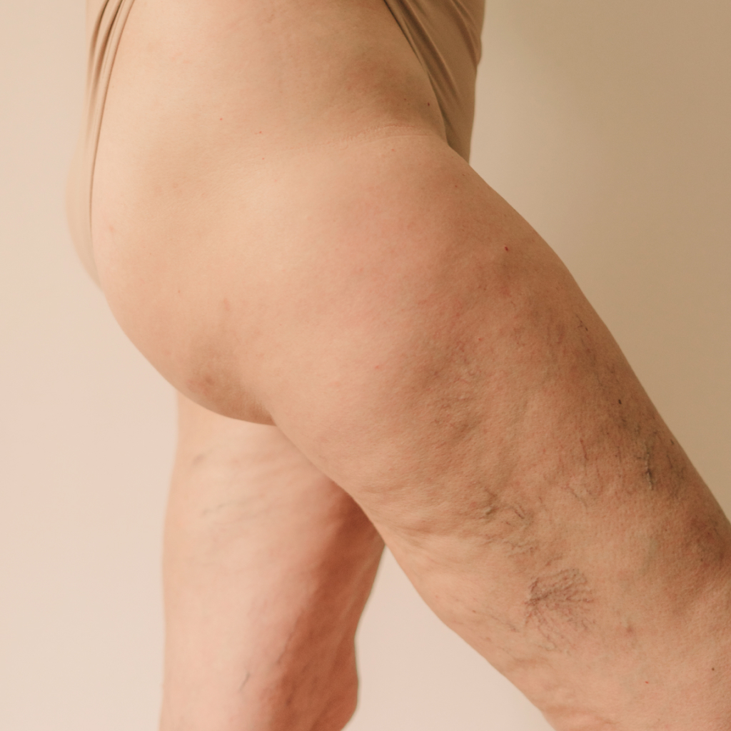 picture of bare thighs with visible veins on a beige background