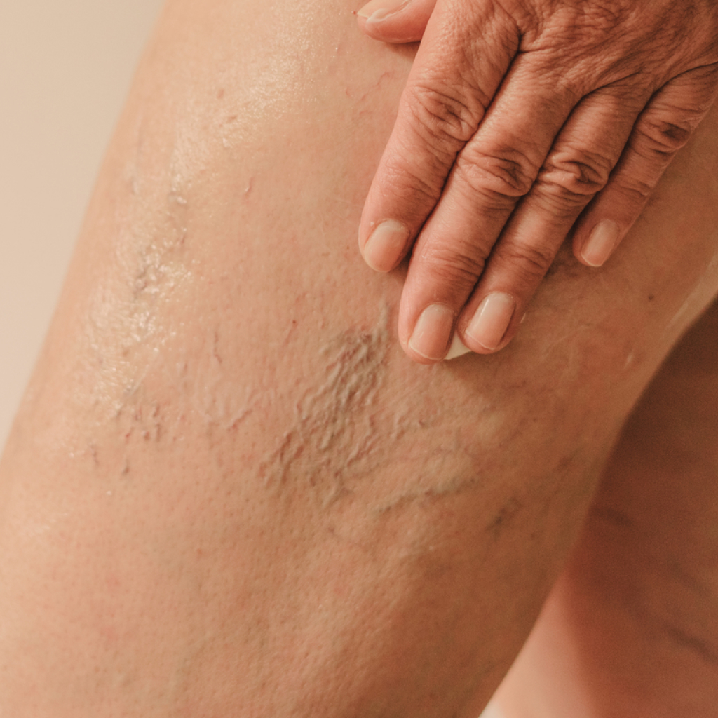 close up of a thigh with spider veins